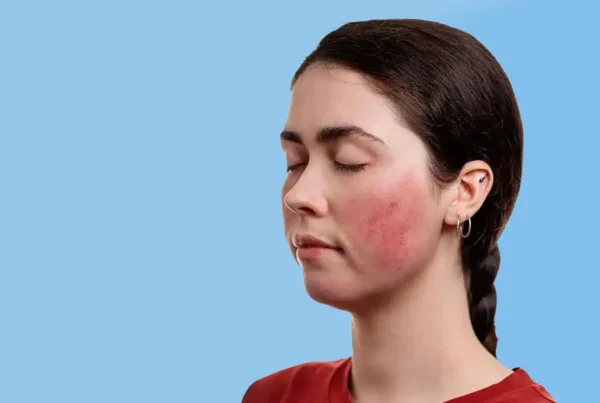 Les stades de la couperose