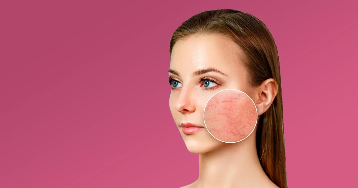 Couperose et Rosacée