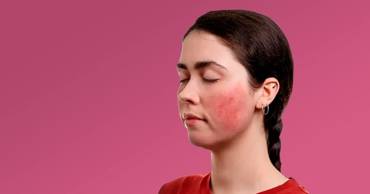 Les stades de la couperose