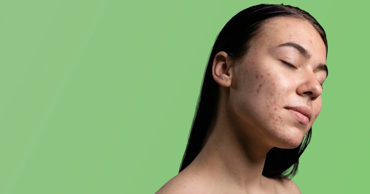 L’acné et le biorythme cutané