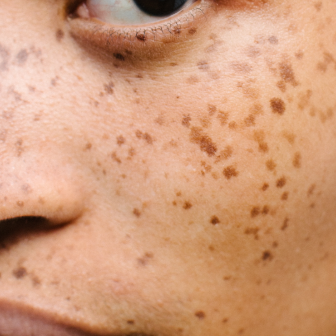 Lentigo