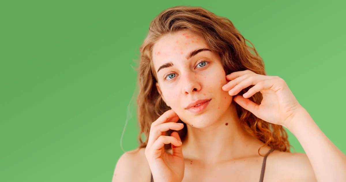 Acné : causes, types